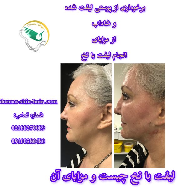لیفت با نخ چیست و مزایای آن