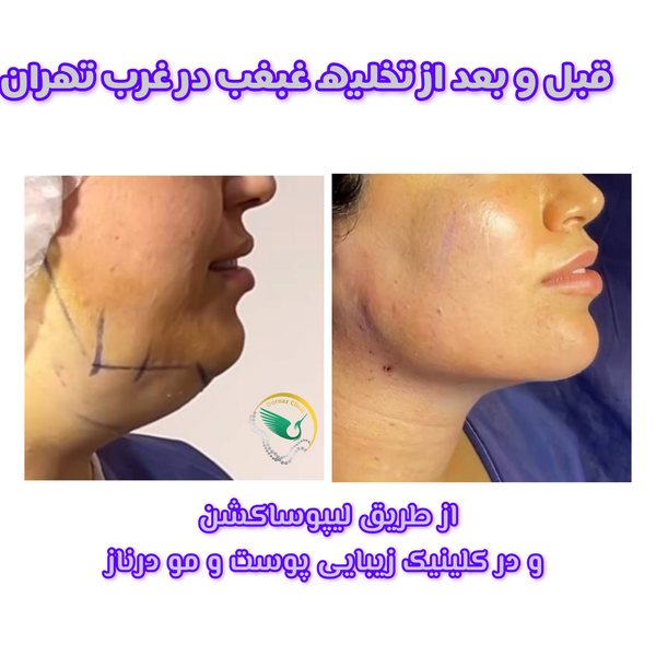 تخلیه غبغب در غرب تهران با لیپوساکش