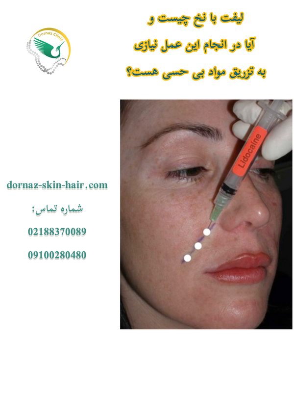 لیفت با نخ چیست؟ مرحله بی حسی