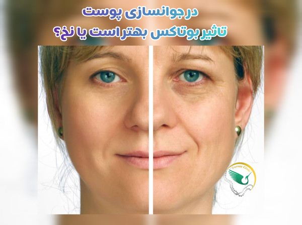 کاربرد بوتاکس بهتر است یا لیفت با نخ
