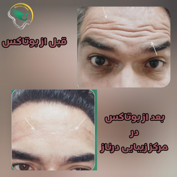 مدت زمان درمان بوتاکس بهتر است یا لیفت با نخ