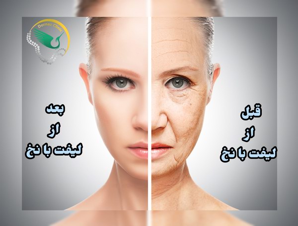سوالات متداول لیفت با نخ، لیفت با نخ به چه کسانی توصیه میود