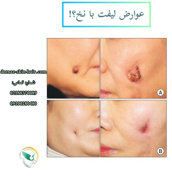 لیفت با نخ چیست و عوارض آن