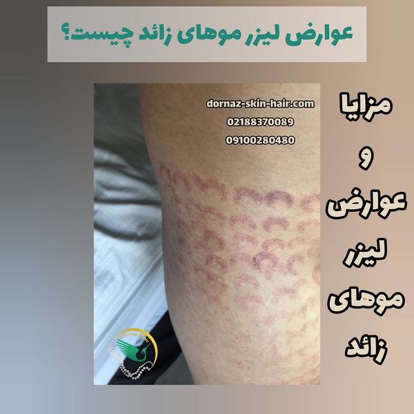 عوارض لیزر موهای زائد