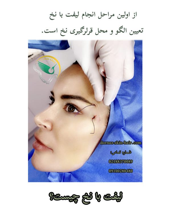 لیفت نخ چیست و تعیین محل آن چگونه است
