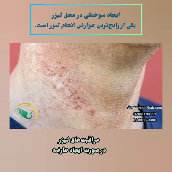 مراقبتهای لیزر و عوارض آن
