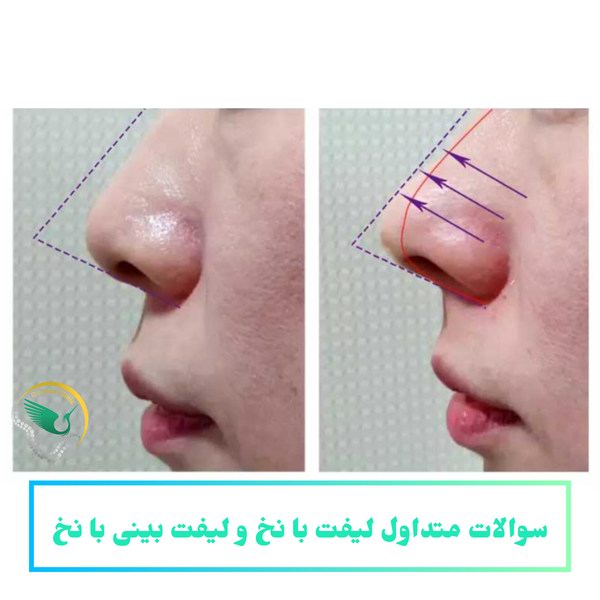 سوالات متداول لیفت با نخ و لیفت بینی با نخ