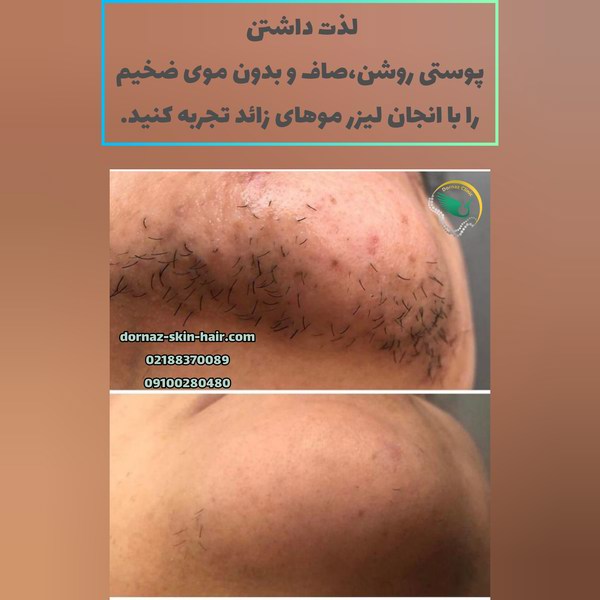 مزایا و عوارض لیزر موهای زائد؛ مزایای روانی آن