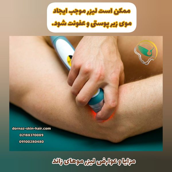 ایجاد موی زیر پوستی و مزایا و عوارض لیزر موهای زائد