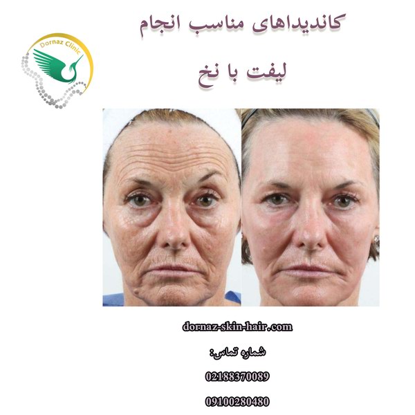 لیفت با نخ چیست و کاندیداهای مناسب انجام آن