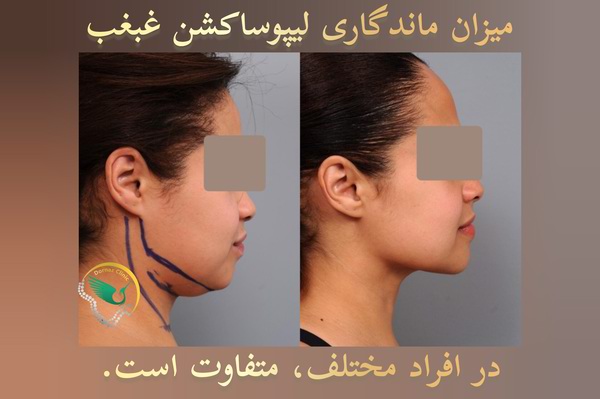 میزان ماندگاری تخلیه غبغب در غرب تهران با لیپوساکشن