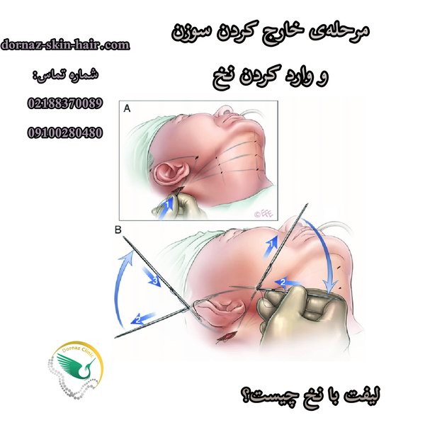 لیفت با نخ چیست؟ وارد کردن نخ و خروج سوزن