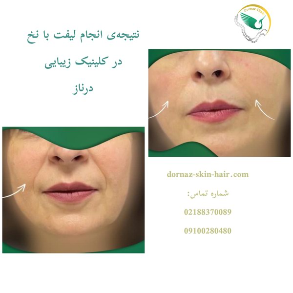 لیفت با نخ چیست؟ و نمونه کار انجام آن در کلینیک درناز