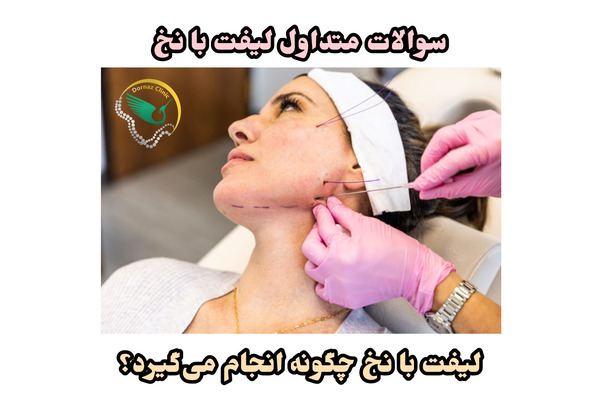 سوالات متداول لیفت با نخ، نحوه انجام لیفت با نخ