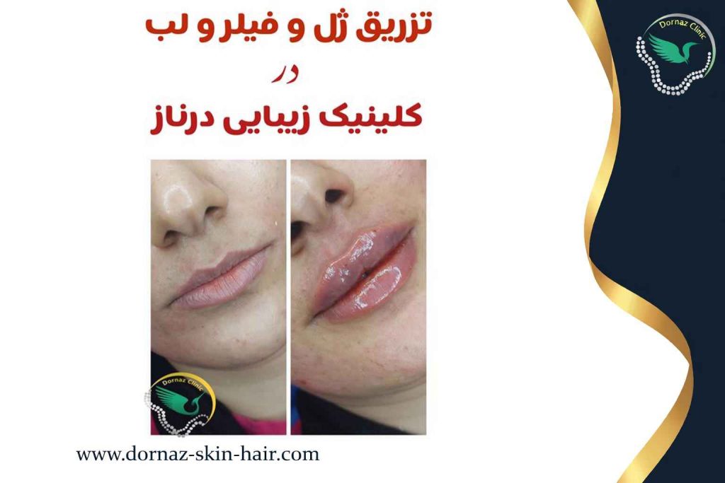 مزایا تزریق ژل و فیلر در شهرک غرب