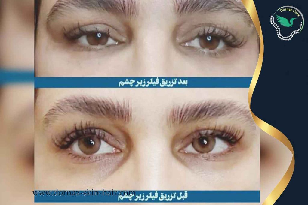 فیلر زیر چشم 