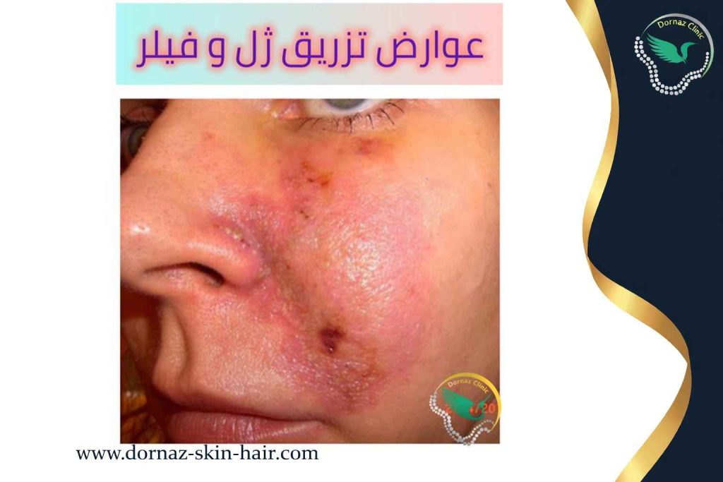 عوارض تزریق ژل و فیلر 