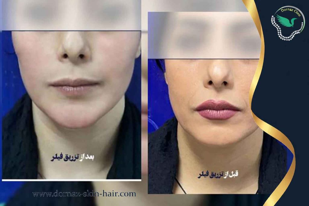 قبل و بعد از تزریق ژل و فیلر در شهرک غرب