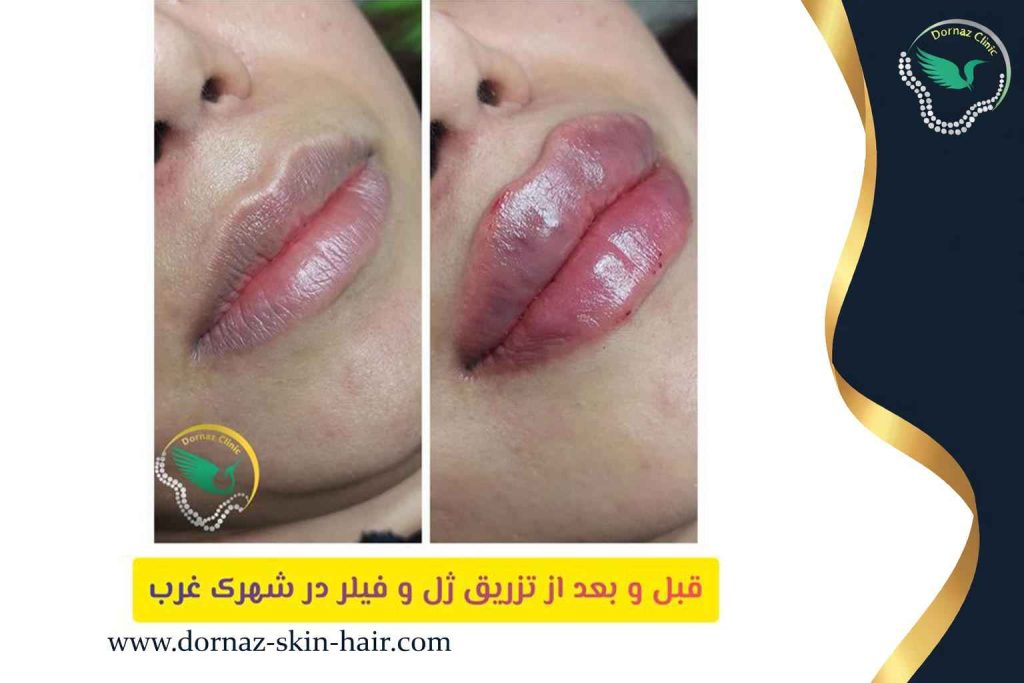تزریق ژل و فیلر در بهترین کلینیک شهرک غرب