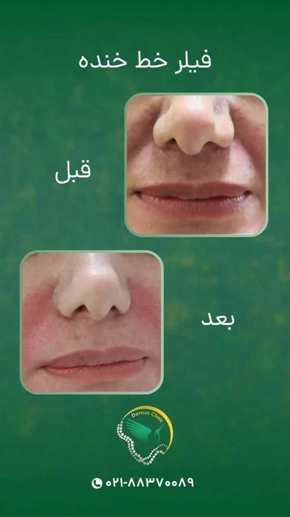 نمونه کار های فیلر لب