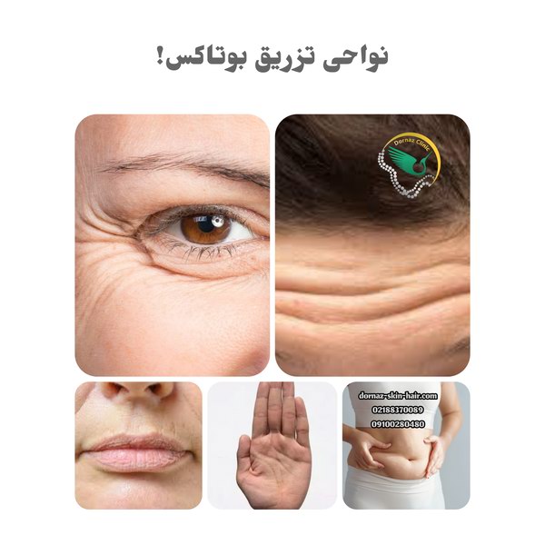 نواحی تزریق بوتاکس