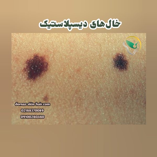 خالها دیسپلاستیک