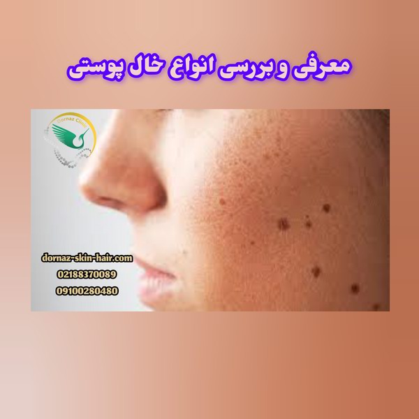 معرفی و بررسی انواع خال پوستی