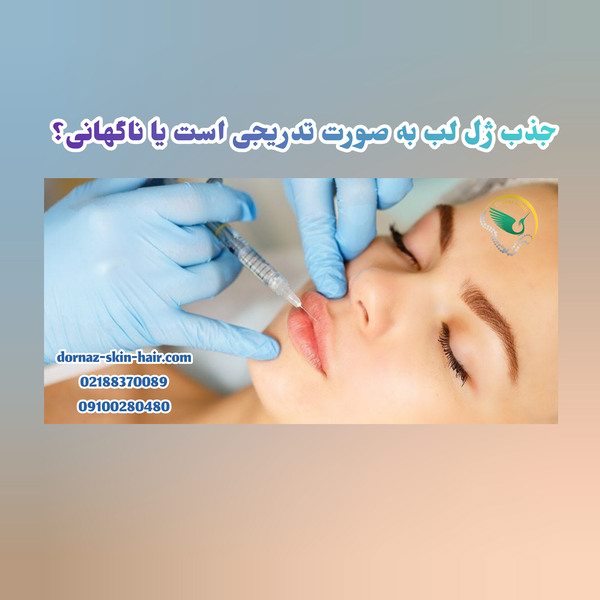 جذب ژل لب تدریجی است یا ناگهانی؟