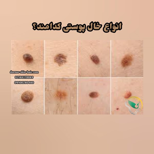 انواع خال پوستی کدامند؟