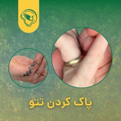 نمونه پاک کردن تاتو با لیزر در شهرک غرب
