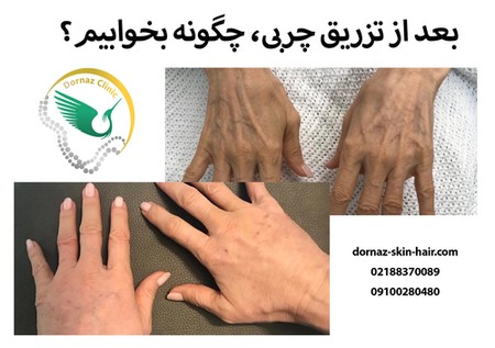 بعد از تزریق چربی
