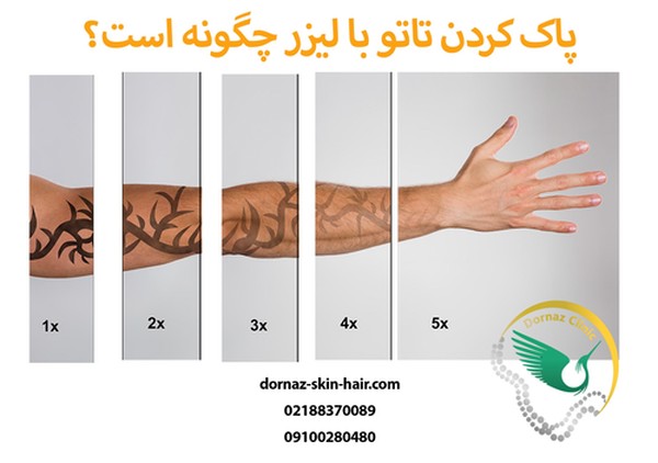 پاک کردن تاتو با لیزر
