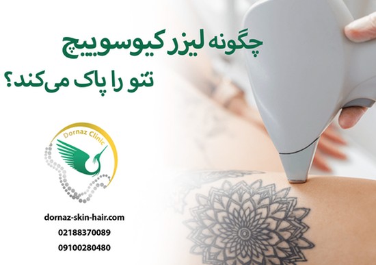 پاک کردن تتو