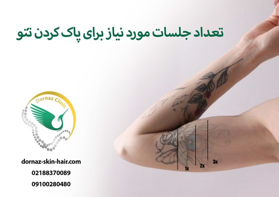 تعداد جلسات لیزر تتو