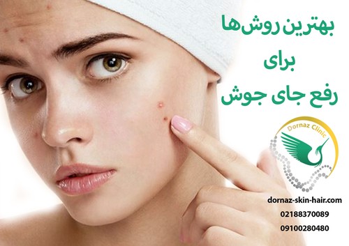برداشتن جوش