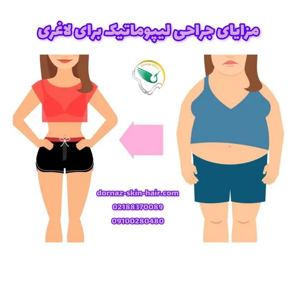 مزایای جراحی لیپوماتیک