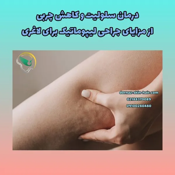 درمان سلولیت با لیپوماتیک
