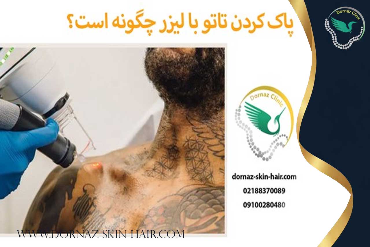 نحوه پاک کردن تتو