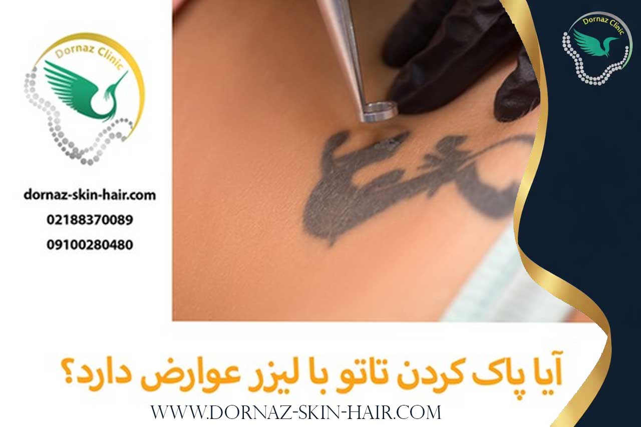 عوارض پاک کردن تتو با لیزر