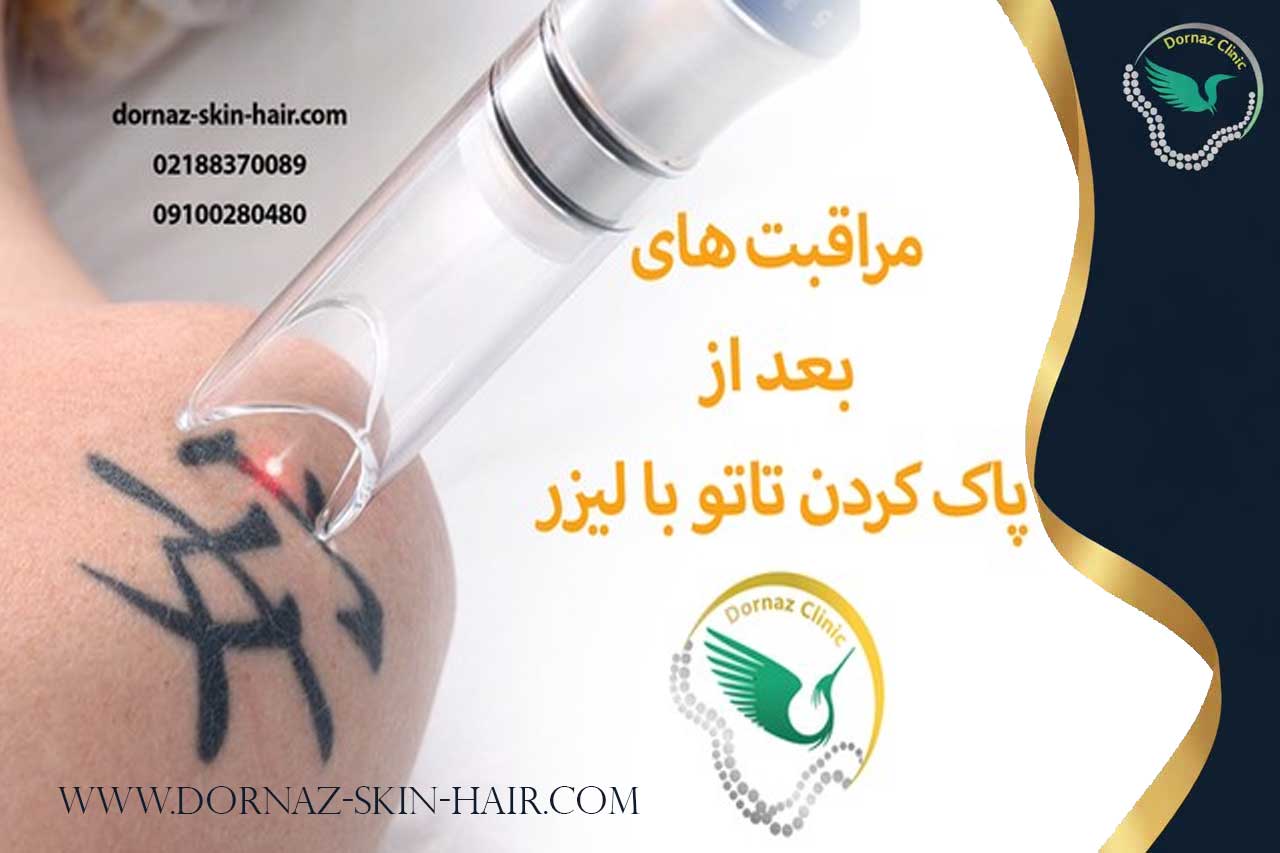 مراقبت بعد از پاک کردن تتو با لیزر