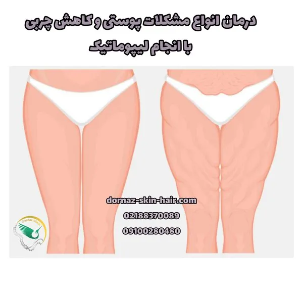 درمان انواع مشکلات پوستی و چربی با جراحی لیپوماتیک