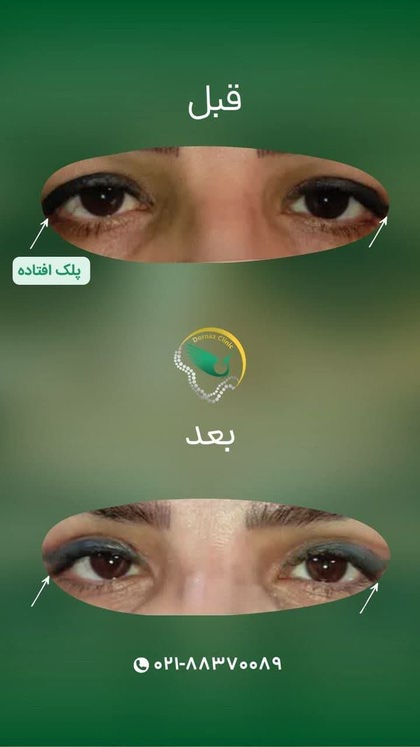 بلفاروپلاستی در غرب تهران