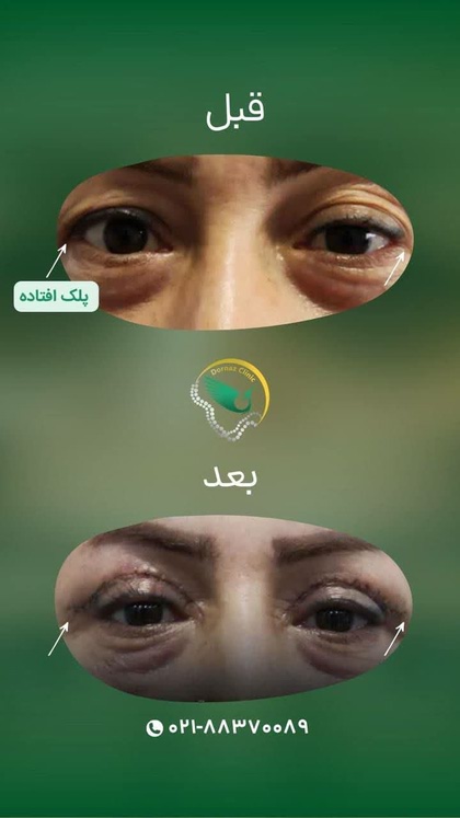 بلفاروپلاستی در غرب تهران در مرکز زیبایی درناز