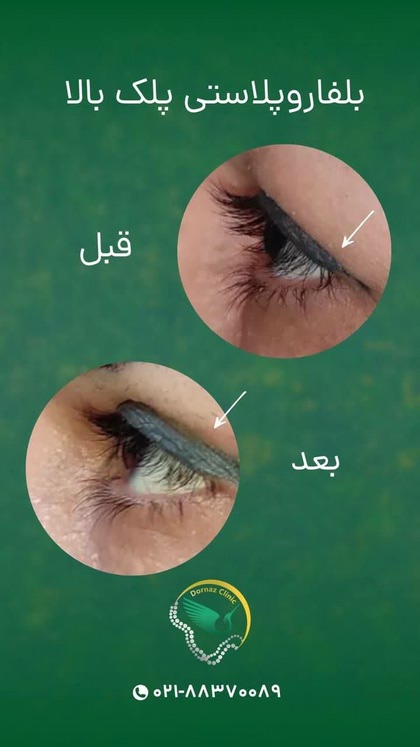 بلفاروپلاستی در غرب تهران