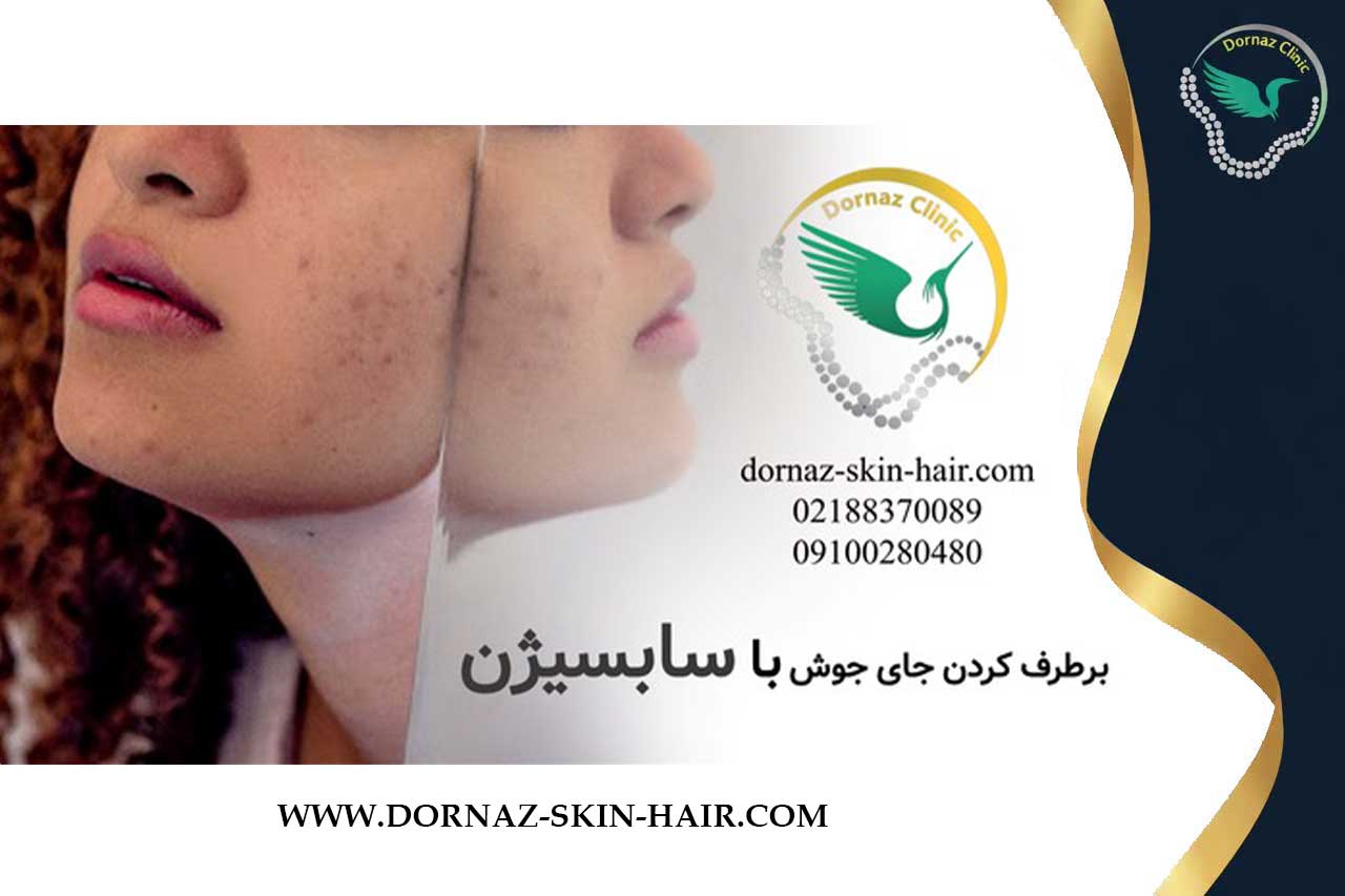 برطرف کردن جای جوش با سابسیژن