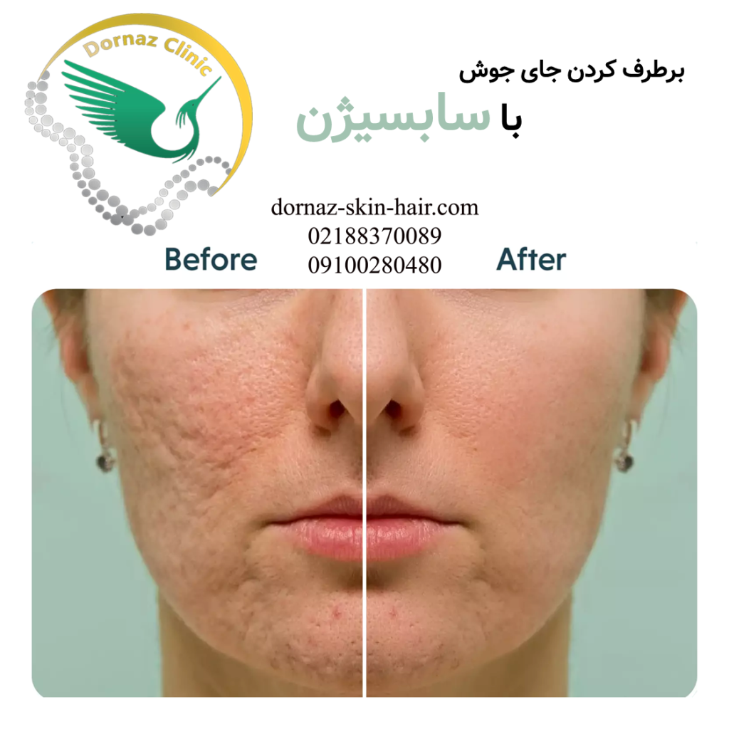 برطرف کردن جای جوش با سابسیژن