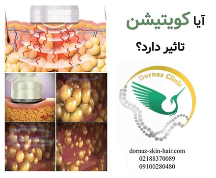 آیا کویتیشن تاثیر دارد؟