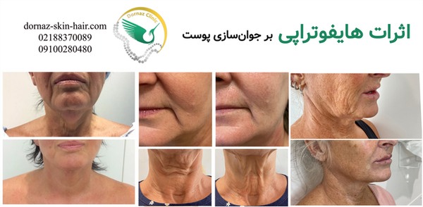 اثرات هایفوتراپی بر جوانسازی پوست