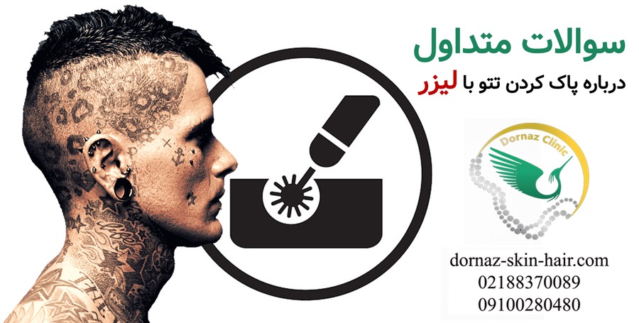 سوالات متداول درباره پاک کردن تتو با لیزر