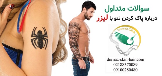 سوالات متداول درباره پاک کردن تتو با لیزر